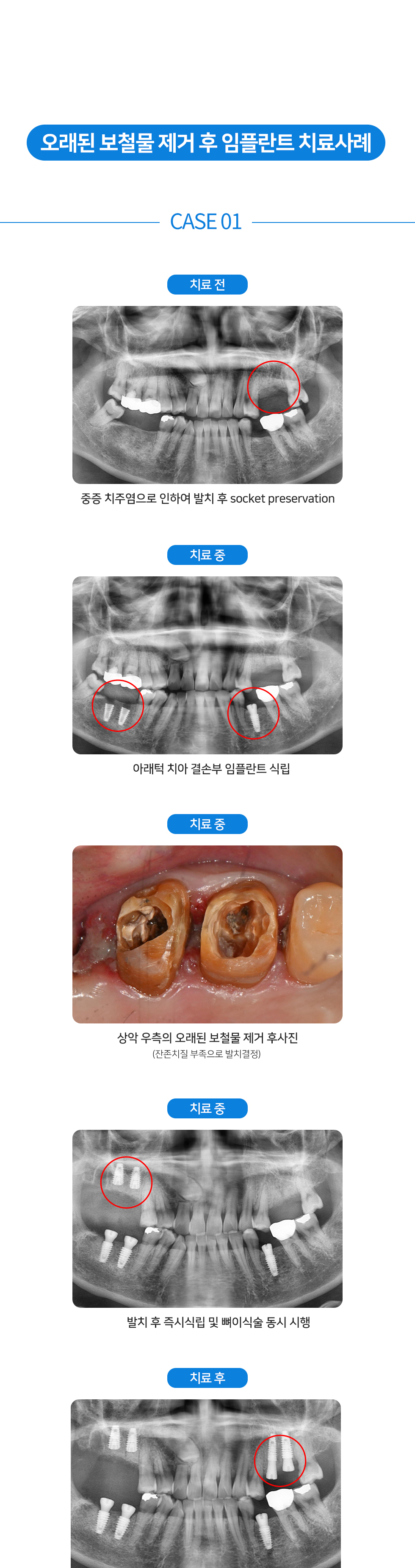 치료전후 1