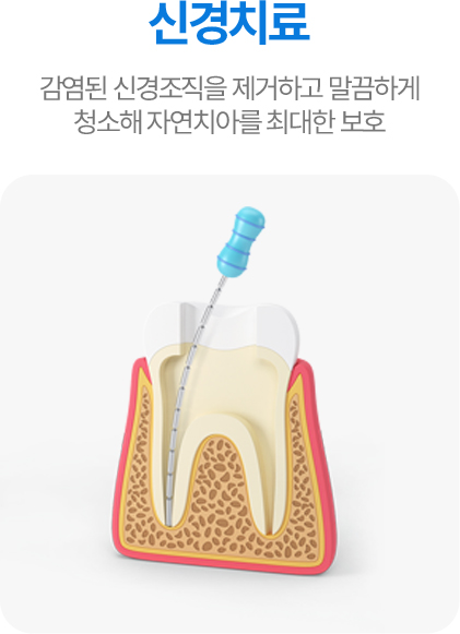 신경치료